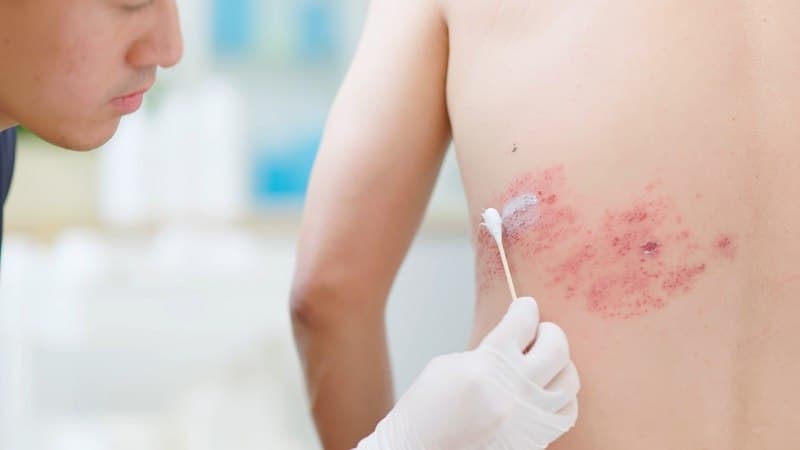 bị zona ngứa phải làm sao