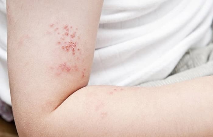 bị zona kiêng ăn thịt gà