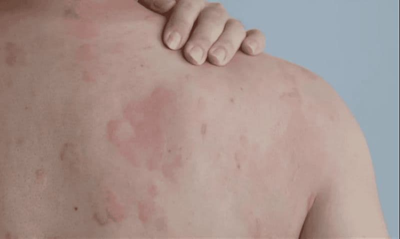 bị zona ăn tôm được không