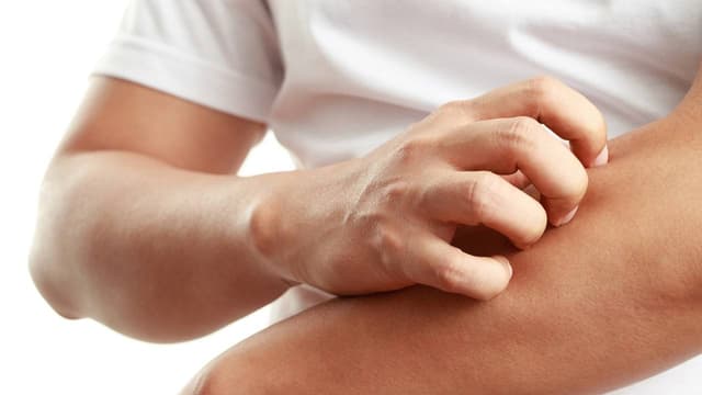 Bị zona ngứa phải làm sao?