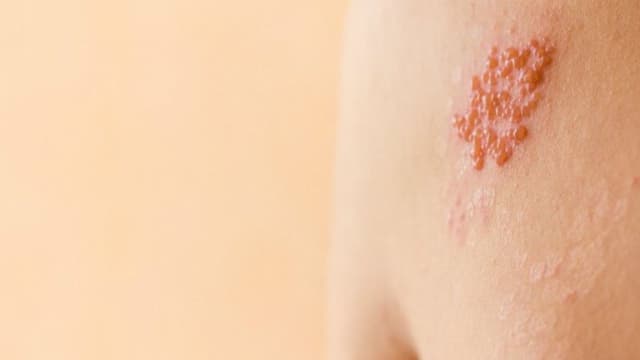 Bị zona rồi có bị lại không?