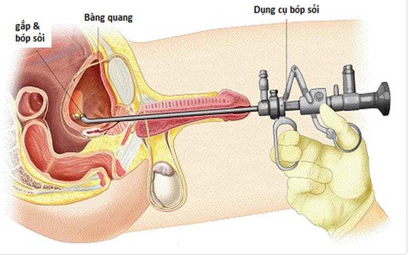 khi nào cần nội soi bàng quang