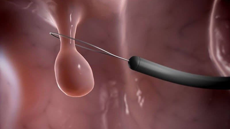 các loại polyp đại tràng