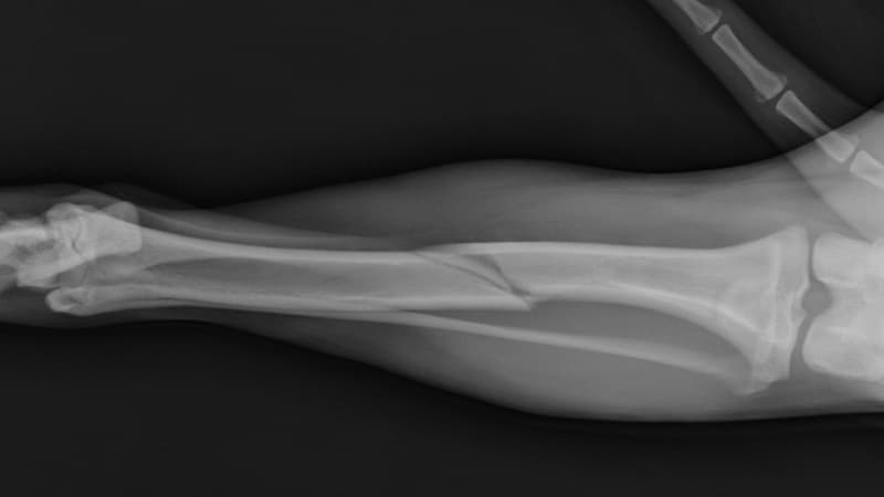 4 giai đoạn liền xương