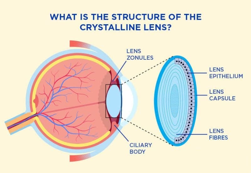 các loại đục thủy tinh thể