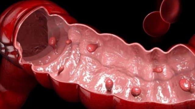 Các loại polyp đại tràng thường gặp