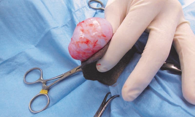 cắt tinh hoàn trong ung thư tiền liệt tuyến