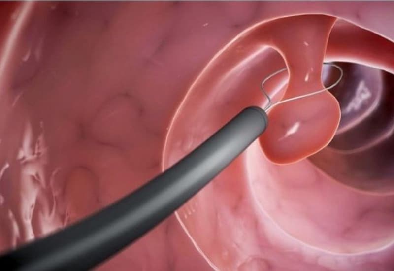 cắt polyp đại tràng phải nằm viện bao lâu