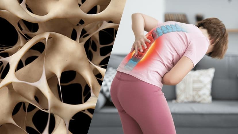 Cơ chế gây loãng xương của corticoid