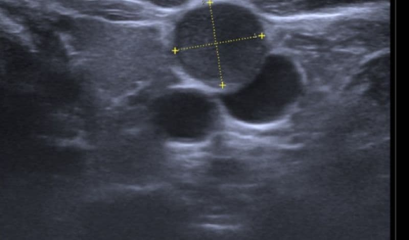 hạch lao trên siêu âm