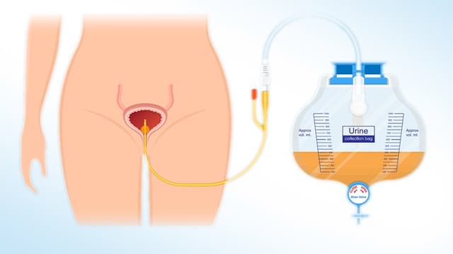 Đặt sonde bàng quang để làm gì? Khi nào cần?