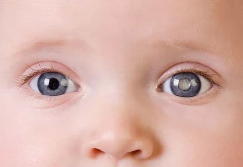 dấu hiệu đục thủy tinh thể ở trẻ sơ sinh