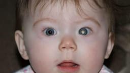 Dấu hiệu đục thủy tinh thể ở trẻ sơ sinh