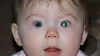 Dấu hiệu đục thủy tinh thể ở trẻ sơ sinh