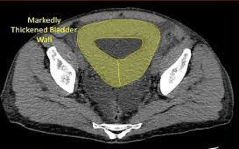 thành bàng quang dày 5mm có sao không