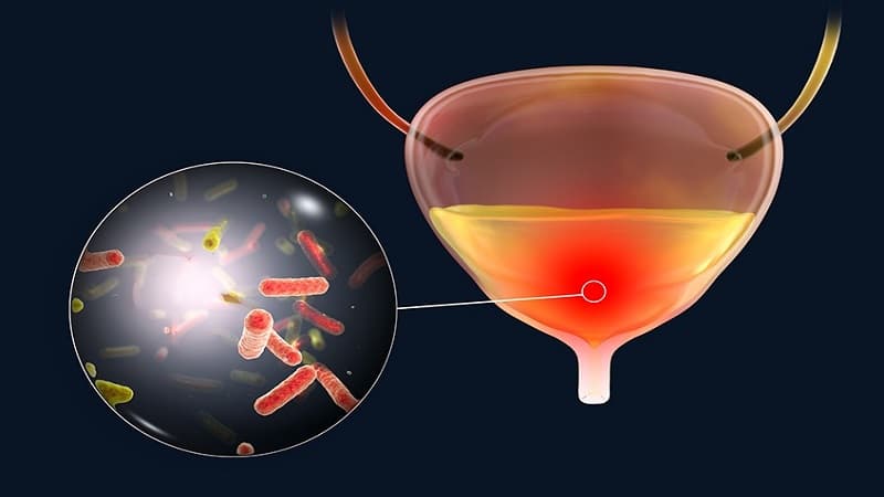 xuất huyết bàng quang là gì