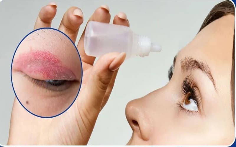 thuốc hạ nhãn áp azopt