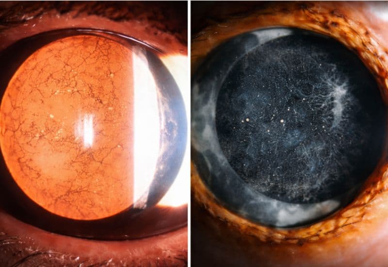 đục thủy tinh thể bao sau là gì