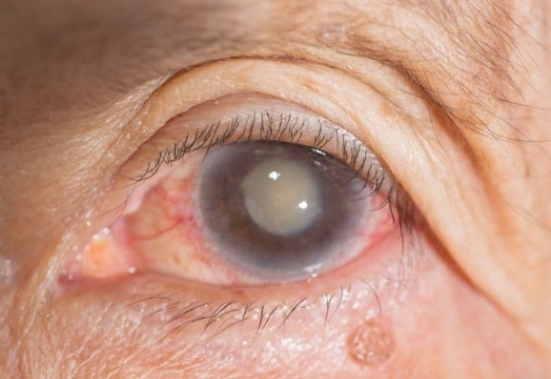 đục thủy tinh thể do đâu