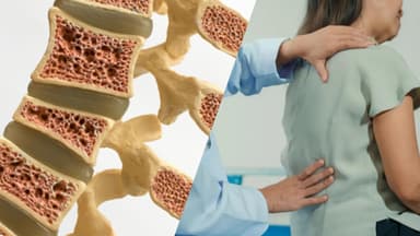 Cảnh giác lún xẹp, gãy đốt sống do loãng xương