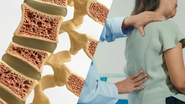 Cảnh giác lún xẹp, gãy đốt sống do loãng xương