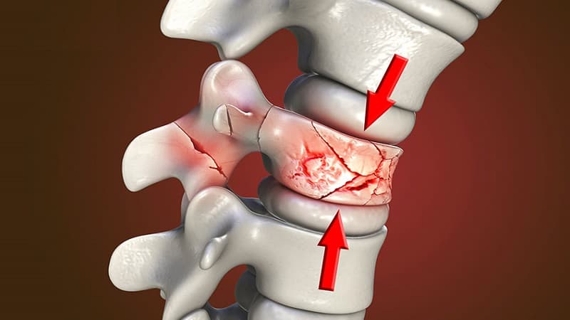 gãy đốt sống lưng L1