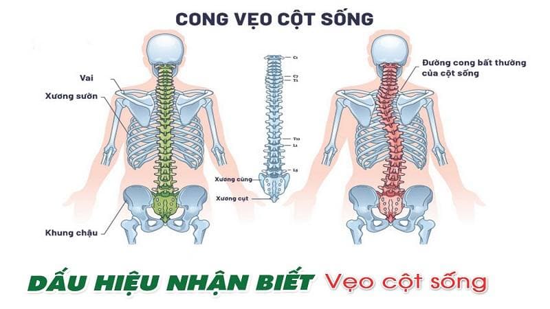 gãy đốt sống lưng L1