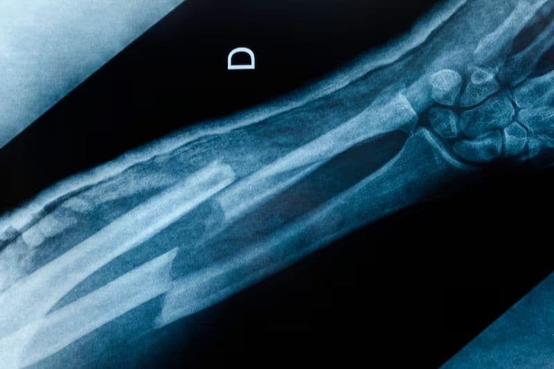 vì sao bệnh loãng xương thường gặp ở người già