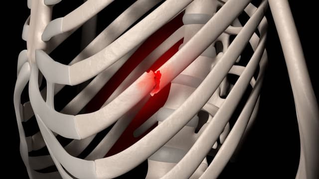 Gãy xương sườn số 8-9 có nguy hiểm không?