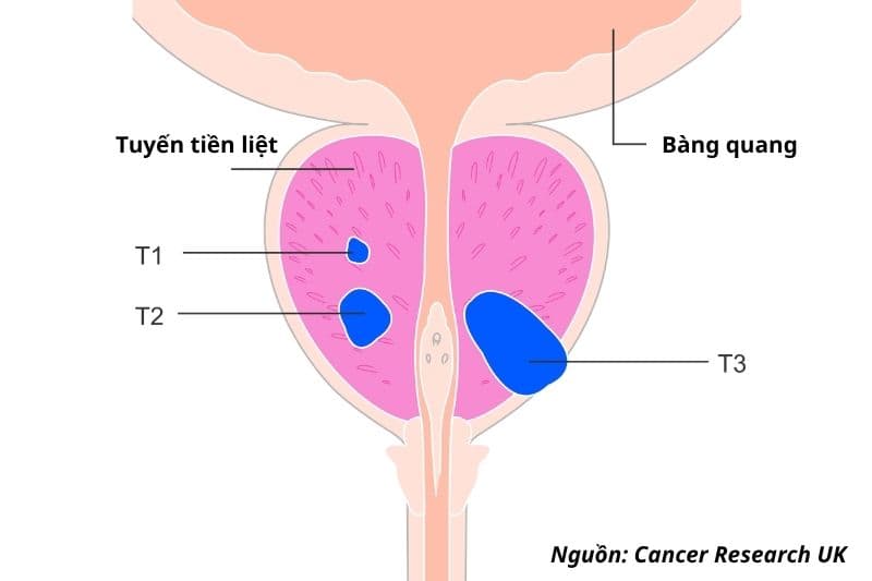 giai đoạn ung thư tiền liệt tuyến