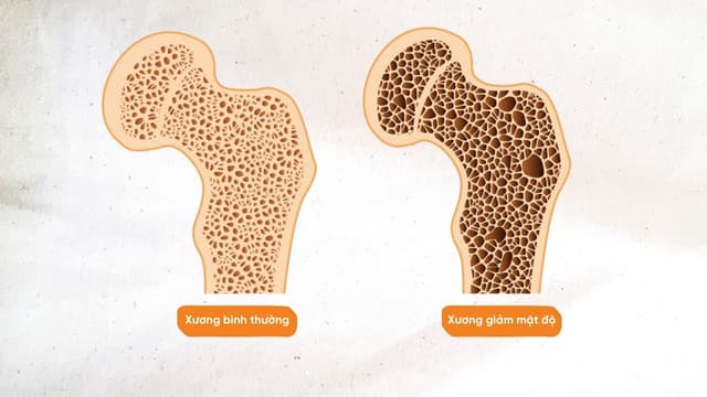 Giảm mật độ xương là gì và làm sao để ngăn chặn?
