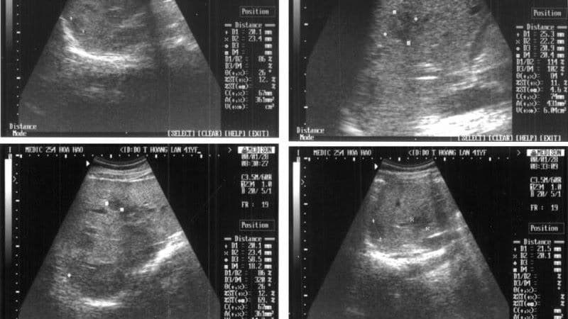 hạch lao trên siêu âm