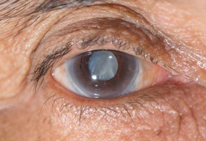 hậu quả của đục thủy tinh thể