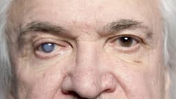 Hậu quả của đục thủy tinh thể nếu không được điều trị