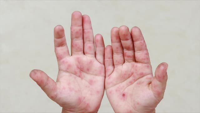 Hình ảnh bệnh tay chân miệng cấp độ 2