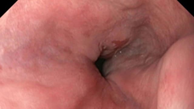 Hình ảnh nội soi thực quản bình thường trông thế nào?