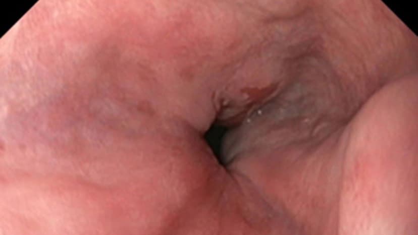 Hình ảnh nội soi thực quản bình thường trông thế nào?