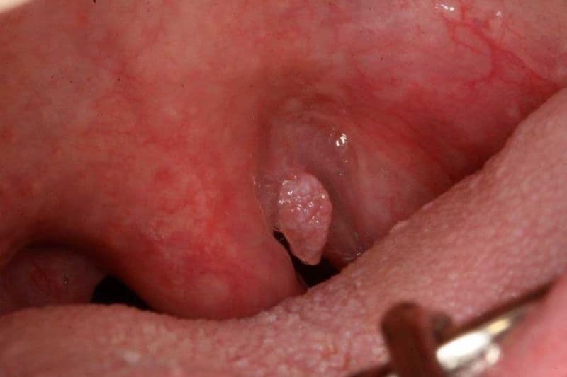 hình ảnh nội soi thực quản bình thường