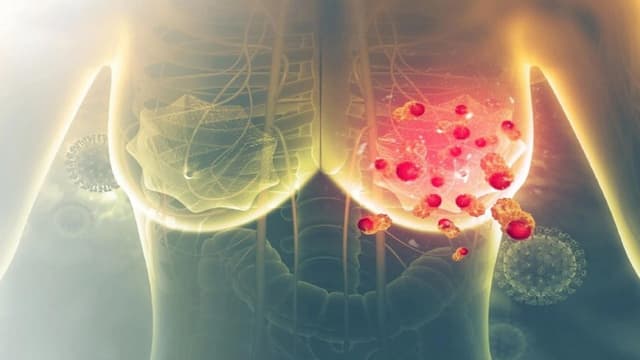 Hướng dẫn chẩn đoán và điều trị ung thư vú Bộ Y tế