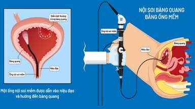 Khi nào cần nội soi bàng quang?