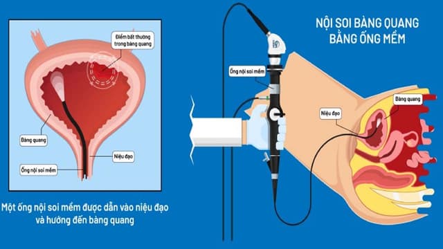 Khi nào cần nội soi bàng quang?