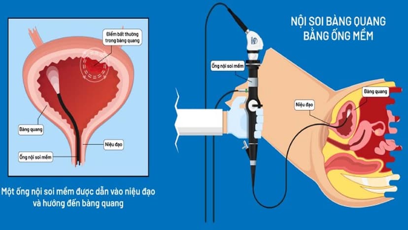Khi nào cần nội soi bàng quang?
