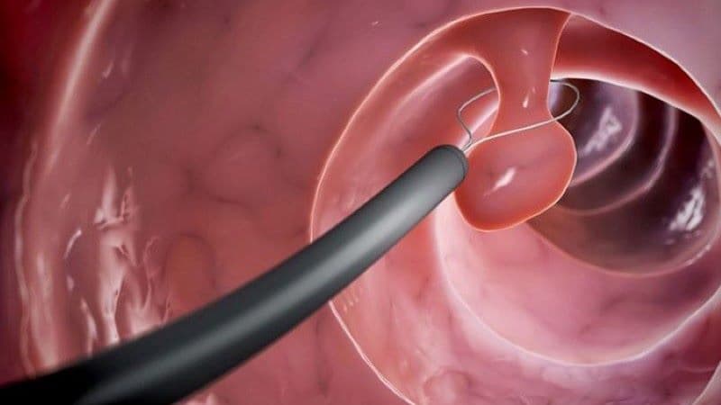 sinh thiết qua nội soi