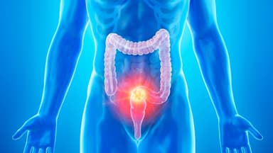 Khi nào cần sinh thiết đại tràng?