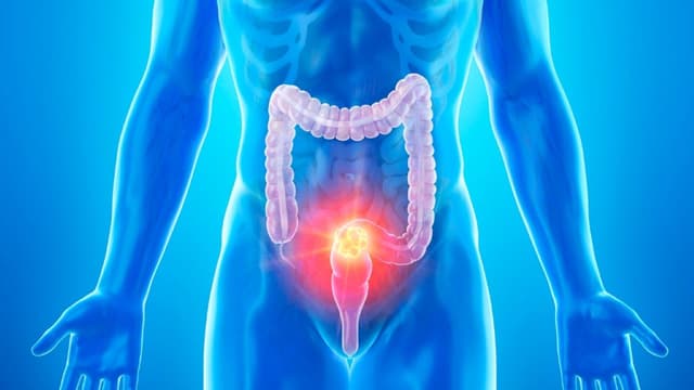 Khi nào cần sinh thiết đại tràng?