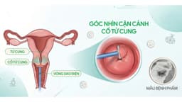 Tiền ung thư cổ tử cung và xử trí kịp thời bằng phẫu thuật khoét chóp