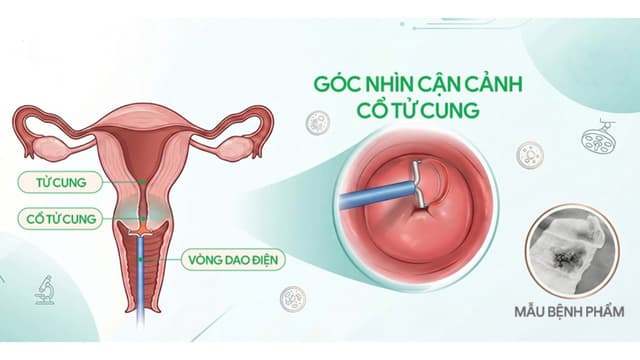 Tiền ung thư cổ tử cung và xử trí kịp thời bằng phẫu thuật khoét chóp