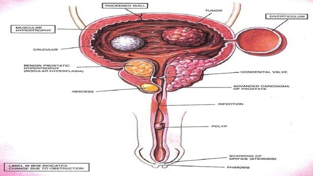 Dấu hiệu có khối u bàng quang ở nam giới