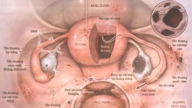 Lạc nội mạc tử cung bàng quang có nguy hiểm?