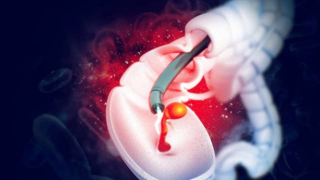 Các lưu ý sau khi cắt polyp đại tràng